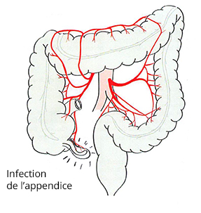 infection de l'appendice