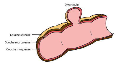 Diverculose du colon sigmoide