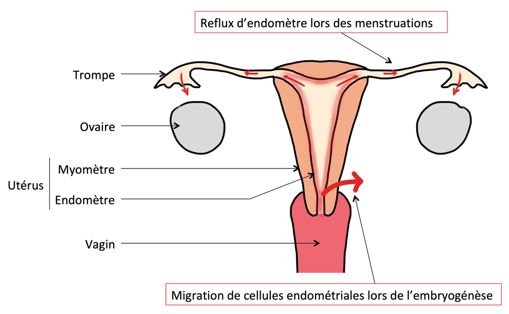 Endometriose - Reflux de cellule