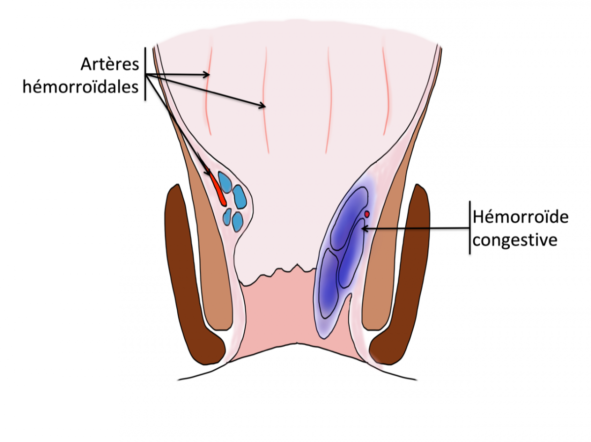 La fistule anale – Hémorroïdes Lyon