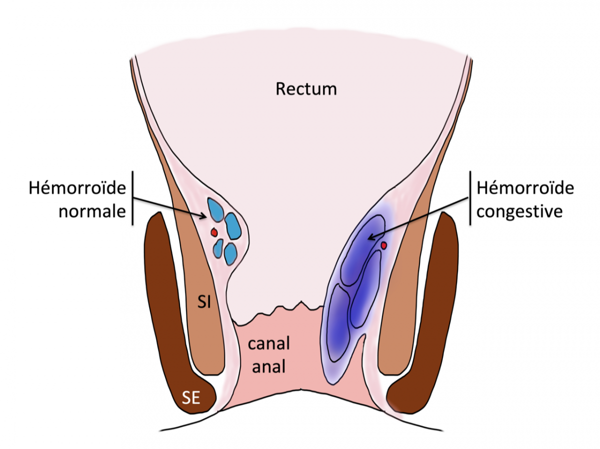 Hémorroides - Docteur Desantis - Chirurgie viscérale et digestive