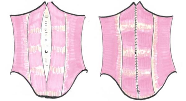 Enfin un traitement mini invasif du diastasis abdominal !