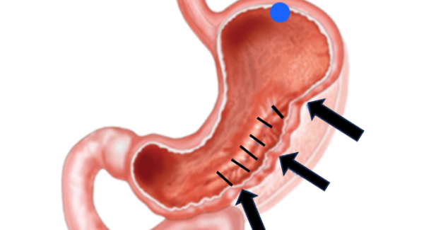 Endosleeve