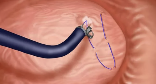 Endo-sleeve
