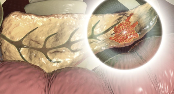 Tumeur neuro-endocrine du pancréas 